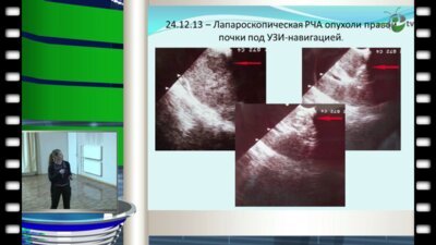 Самарцева К.М. - "Формирование иммунного ответа на радиочастотную абляцию рака почки"