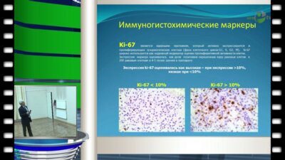 Горелов А.И. - "Прогностическое значение маркеров Ki-67 и Vimentin у больных с метастатическим раком почки"