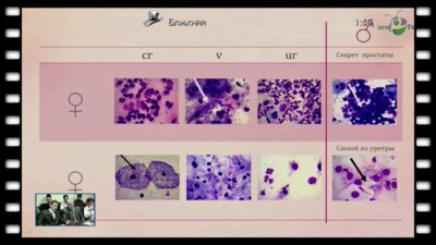 Зенина Ю.В. - "ЗНАЧЕНИЕ CANDIDA ALBICANS ПРИ МОЧЕПОЛОВОЙ ИНФЕКЦИИ"