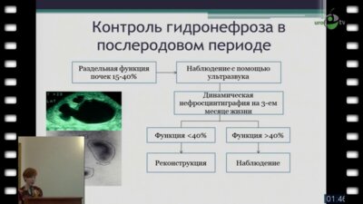 Задера Е.В. - "Лапороскапическая пиелопластика у детей"