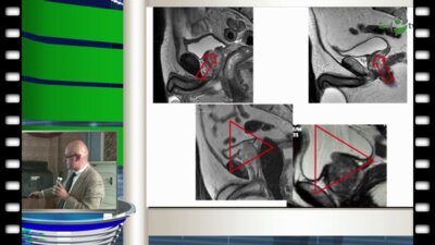 Пушкарь Д.Ю. - Робот-ассистированная радикальная простатэктомия: сложные случаи
