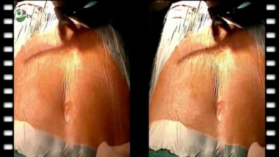 Видеоэндоскопическая экстраперитонеальная нервосберегающая радикальная простатэктомия (3D)