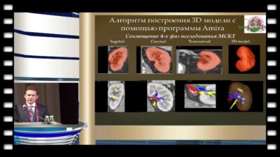 Шпоть Е.В. - "Трехмерное моделирование анатомических и патологических структур при заболеваниях почки и программное обеспечение для 3D-визуализации в урологии"