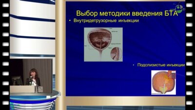 Тур Е.И. - "Внутридетрузорные инъекции ботулинического токсина типа А у больных идиопатической детрузорной гиперактивностью и гиперактивным мочевым пузырем без детрузорной гиперактивности"