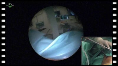 Гаджиев Н.К. -  "Стандартная перкутанная нефролитотрипсия»