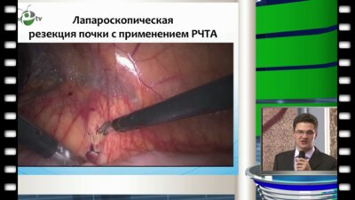 А.С. Калпинский - Лапароскопические и малоинвазивные технологии у больных раком почки
