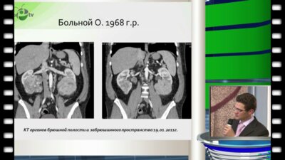 Клинический случай - первично-множественный синхронный рак почек