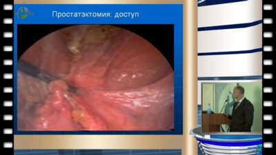 Чудновец И.Ю. - Лапароскопическая простаэктомия