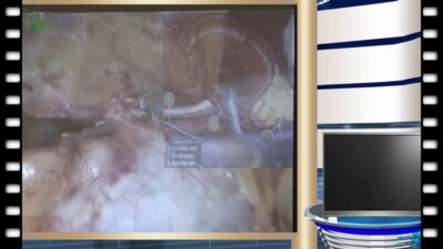 Галлямов Э.А. - Хирургическое лечение опухолей почек