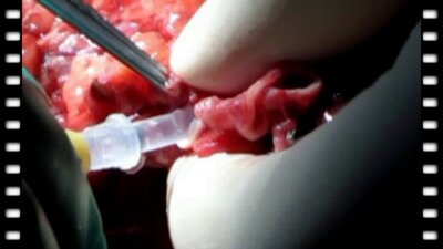 Аутотрансплантация почки в лечении протяженных дефектов мочеточников