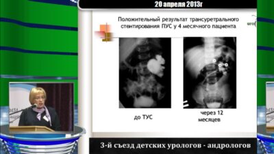 Ростовская В.В. "Новые знания об уродинамике лоханки в норме и при пренатально диагностированном гидронефрозе"