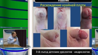 Каганцов И.М. "Осложнения пластики крайней плоти при коррекции дистальной гипоспадии у детей"