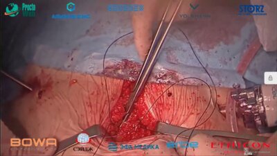 Агапов М.А., Маркарьян Д.Р. - Резекция левых отделов ободочной кишки