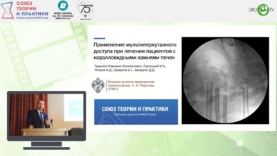 Гаджиев Н.К. - Применение мультиперкутанного доступа при лечении пациентов с коралловидными камнями почек