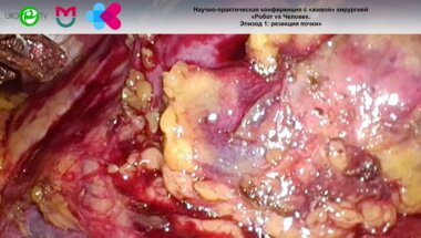 Попов С.В. - Лапароскопическая резекция почки