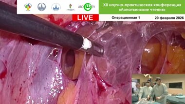 Лапароскопическая резекция почки 3D. Оператор Попов С.В.