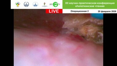 Ретроградная интраренальная хирургия с аспирационным кожухом. Оператор Малхасян В.А.