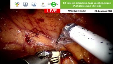 Робот-ассистированная резекция почки. Оператор Шпоть Е.В.