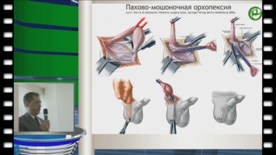 Игнатьев Р.О. - Хирургические методы лечения крипторхизма у детей