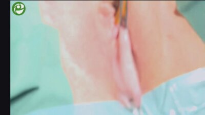 Реконструкция тазового дна  при цистоцеле 3 ст. с апикальным дефектом 2 ст.