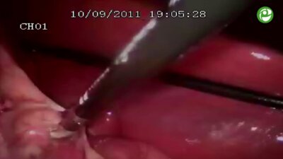 Лапароскопическая нефрэктомия