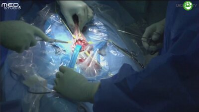 Муннарис Р. - Фаллопротезирование трехкомпонентным фаллопротезом Сoloplast Titan Touch через мошоночный доступ