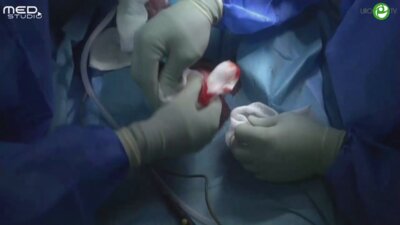 Валензуэла Р. - Фаллопротезирование трехкомпонентным фаллопротезом Сoloplast Titan Touch через инновационный завенечный доступ