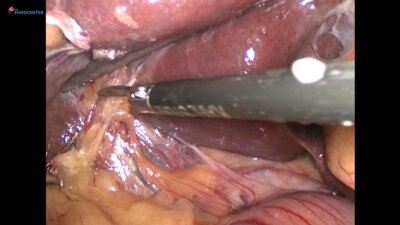 Laparoscopic choledoholitotomy&IPOM hernia repair LIVE