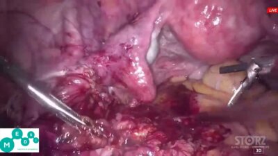 Laparoscopic cystic augmentation LIVE _ Лапароскопическая аугментация мочевого п
