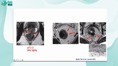 Regina Beets-Tan - MRI Radiology for Rectal. Lecture from Europe