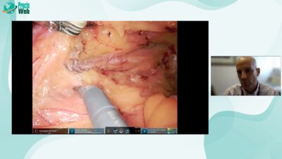 Brain Bednarski - Management of the IMA and splenic flexure mobilixation