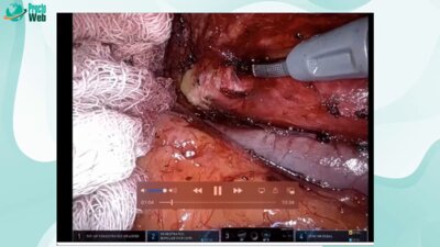 Tsuyoshi Konishi - Advanced MIS For Rectal Cancer. Recurrent Rectal Cancer