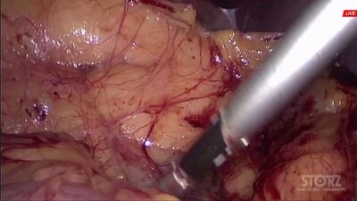 Операция . Галлямов Э.Д. - Лапароскопическая пластика мочеточника