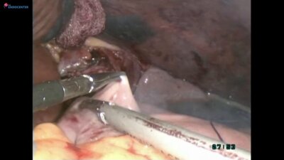 Laparoscopic gastrectomy BMI 40 hand sewn EEA