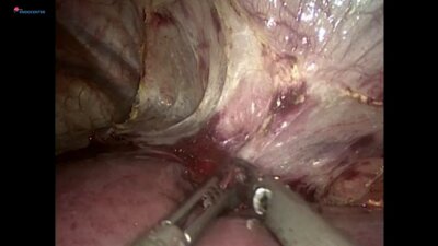 Laparoscopic hepatic resection S2,3,1