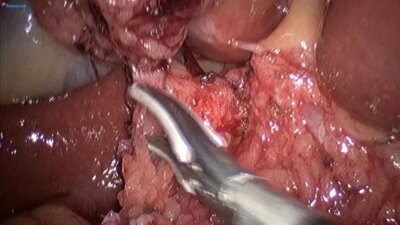 Laparoscopic Hepaticojejunostomy LIVE