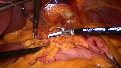 Laparoscopic Hiatal hernia