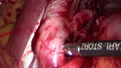 Laparoscopic Huge pelvic tumor