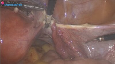 Laparoscopic hysterectomy LIVE