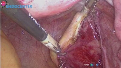 Laparoscopic hysterectomy, promontoficsation
