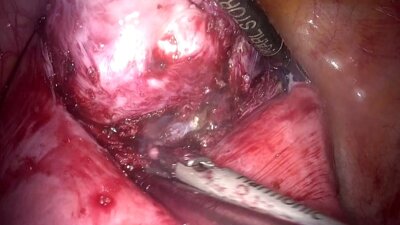 Laparoscopic Myomectomy & promontoficsation _ Консервативная миомэктомия, сакров (1)