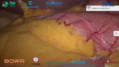 Галлямов Э.А. - Оперативное лечение грыжи пищеводного отверстия диафрагмы