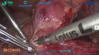 Галлямов Э.А. - Лапароскопическая цистоскопия операция Брикера