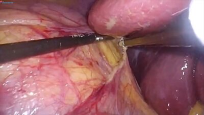 Laparoscopic Ormond's biopsy, UPJ plasty LIVE Лапароскопическая биопсия и пластика ЛМС