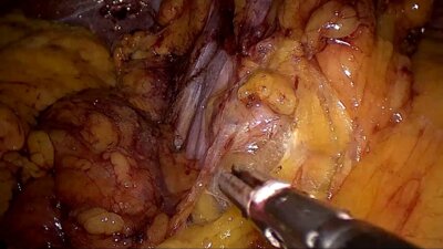 LaparoscopIc pancreatoduodenectomy (Whipple procedure) LIVE _ Лап. панкреатодуод
