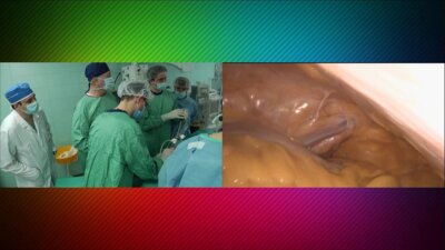 Laparoscopic partial nephrectomy LIVE - Резекция почки
