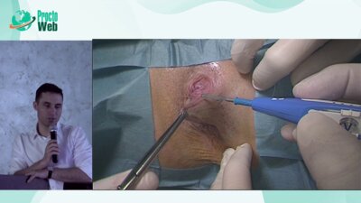 Агапов М.А. - Оперативное лечение геморроидальной болезни