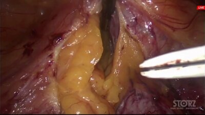 Laparoscopic pyeloplasty _ Лапароскопическая пластика ЛМС