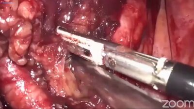 Laparoscopic Radical cystectomy Bricker derivation LIVE _ Радикальная цистпростатэктомия