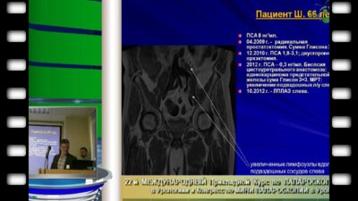 Владимир Сергеев "Повторные операции в онкоурологии открыто или лапароскопически"